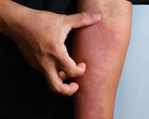atopic dermatitis scratching arm