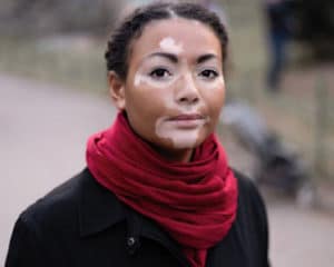 young woman with vitiligo on her face