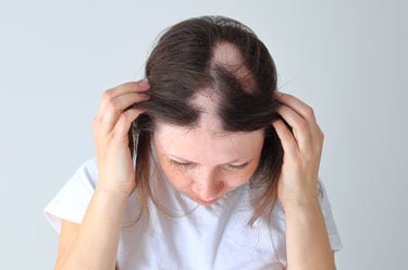 Young girl with Alopecia Areata on her scalp